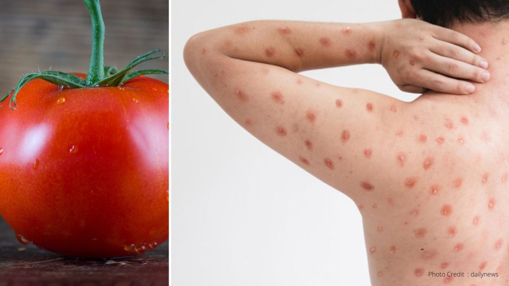 Tomato Flu in India, Central Govt Releases Tomato Flu Guide Line, What Are Tomato Flu Symptoms And Remedies, Know More