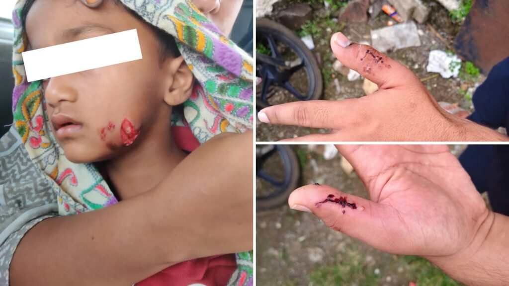 Dog attack in Jamkhed Municipal Council area, five to six people injured in a single day, two children seriously injured, treatment underway at district hospital